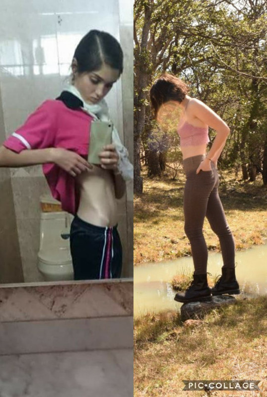 Schoolgirl Who Developed Anorex