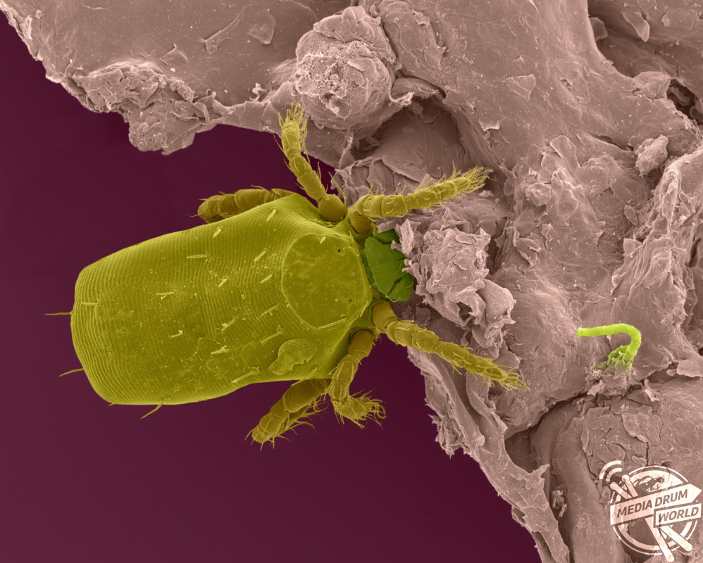 Coloured scanning electron micrograph (SEM) of Chigger, harvest mite larval ectoparasite (Trombicula sp.) on human epidermis (skin). Trombicula is a genus of harvest mites (also known as red bugs or berry bugs) from the Trombiculidae family. In their larval stage they are known as chiggers (or chigoe) and they attach to various animals, including humans, rabbits, toads, box turtles, quail, and even some insects. After crawling onto their hosts, they inject digestive enzymes into the skin that break down skin cells. They do not actually bite, but instead form a hole in the skin called a stylostome, and chew up tiny parts of the inner skin, thus causing severe irritation and swelling. This feeding process on skin causes severe itching. The larval stage is parasitic on humans and causes the disease called chigger dermatitis. Magnification: x34 when shortest axis printed at 25 millimetres. SPL / mediadrumworld.com