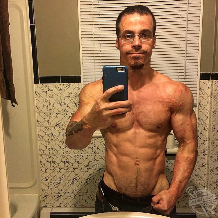 This Man Experienced Devastating Burns As A Boy But Now Flexes his ...