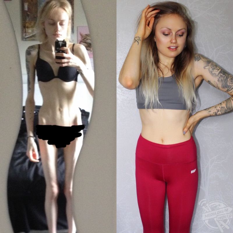 A student who struggled with anorexia since she was 12 saw her weight drop ...