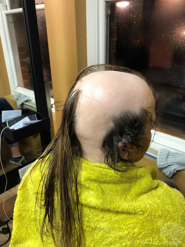 Not Quite A Teenage Dream: Alopecia Hit This Irish Girl At The Age Of  Sixteen | Media Drum World
