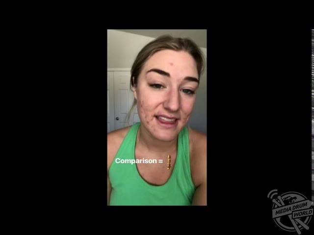 Cystic Acne Sufferer Talks Accepting Her Skin And Finding Love Despite Once Being Terrified Of Dating