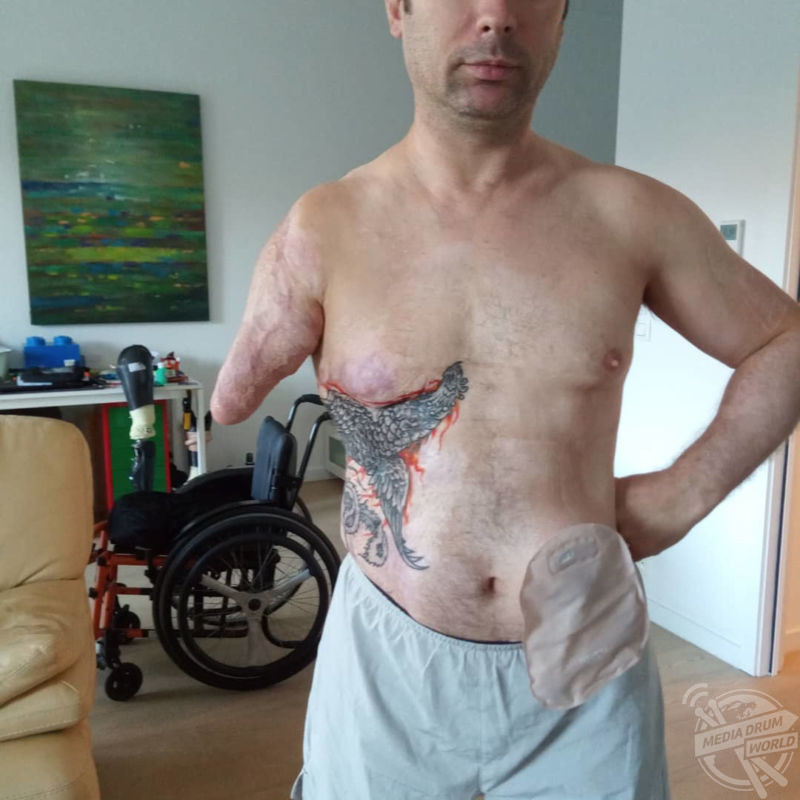 Man Wakes From Coma To Find Three Of His Limbs Amputated After Terrifying High Speed Collision