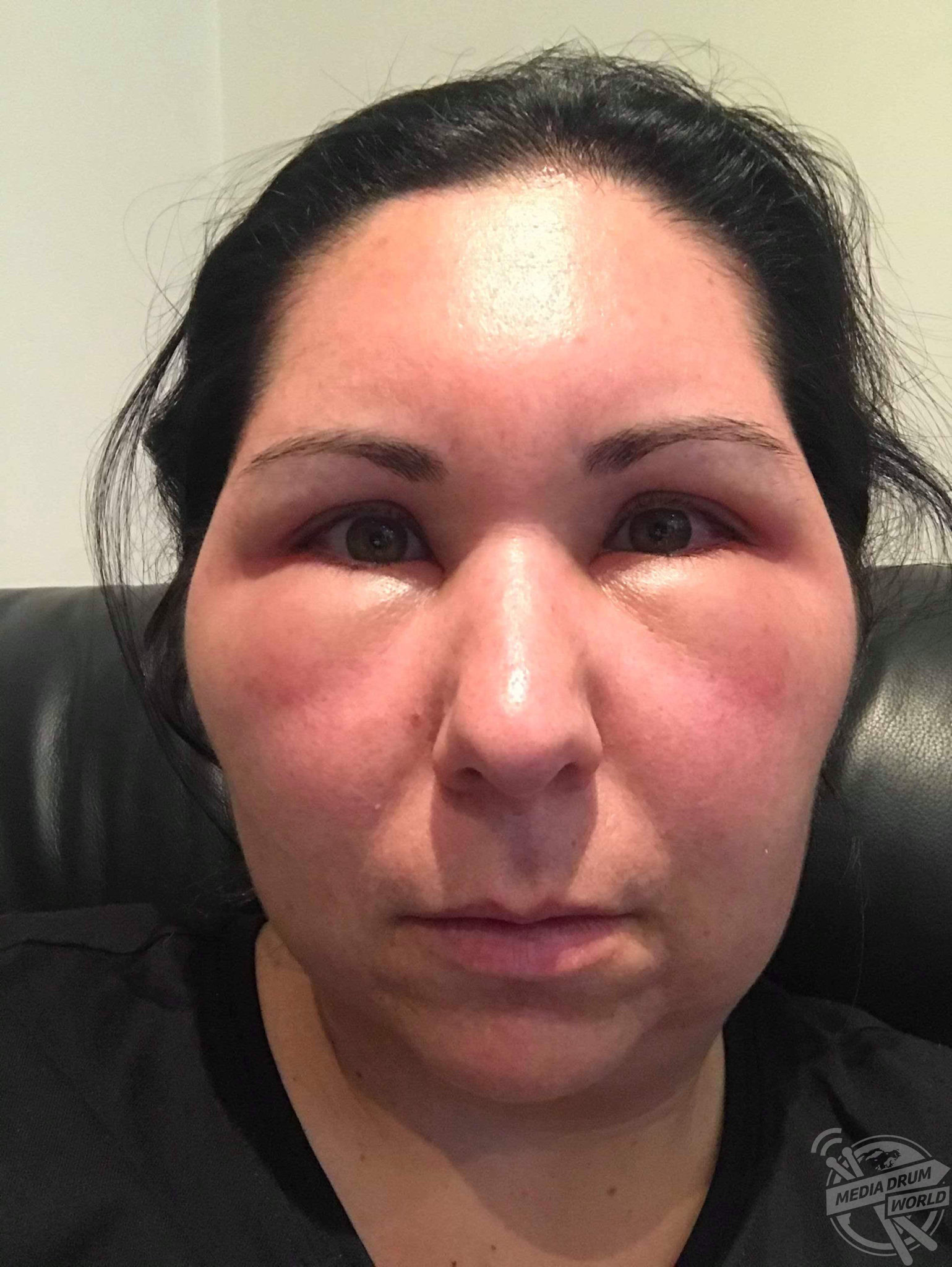 Woman's Face Balloons After Severe Allergic Reaction To Hair Dye ... Makeup Allergic Reaction