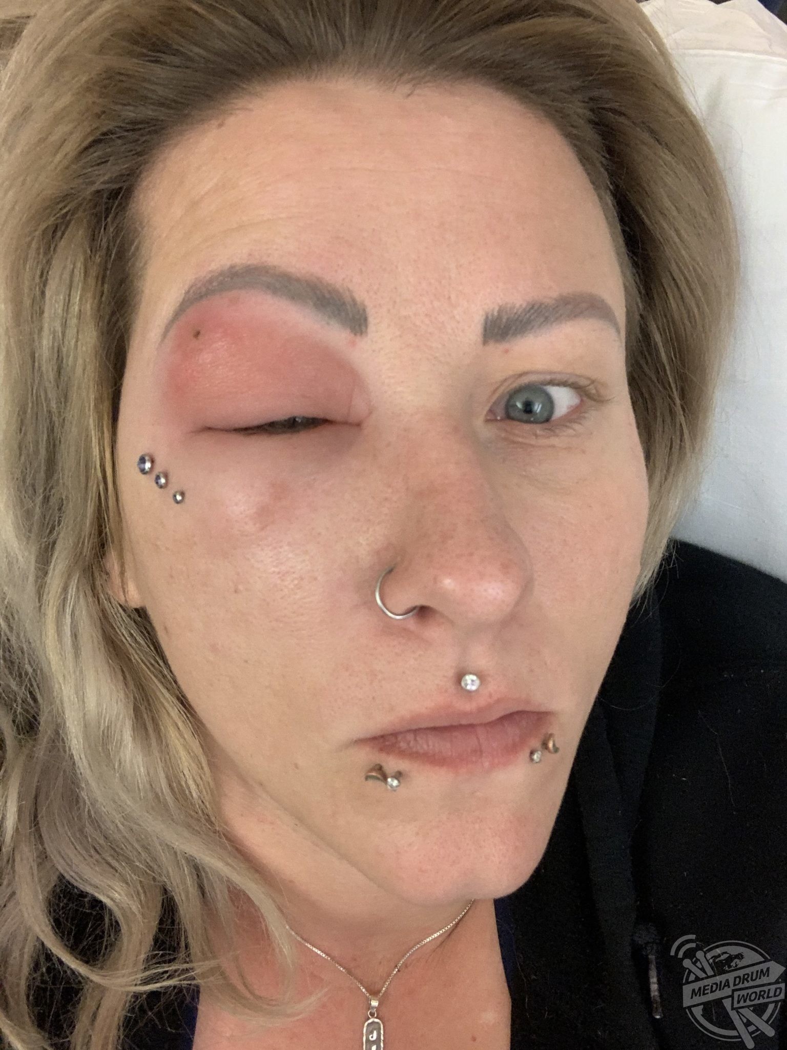 Hairdresser Nearly Lost Her Eye After Hair Splinter Caused Infection |  Media Drum World