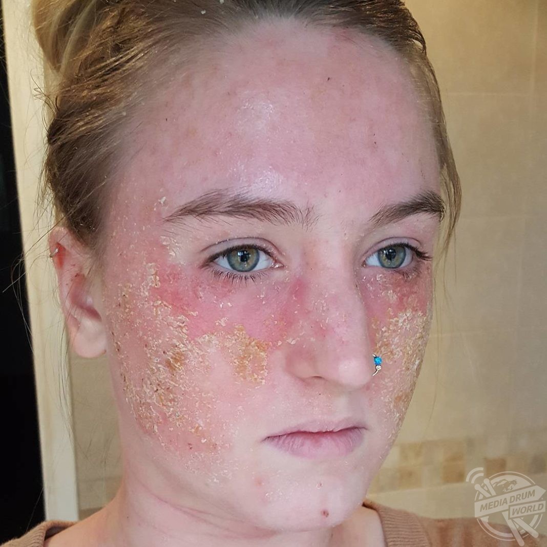 Woman Became A Hermit After Eczema Made Her Embarrassed To Be Seen In Public Media Drum World