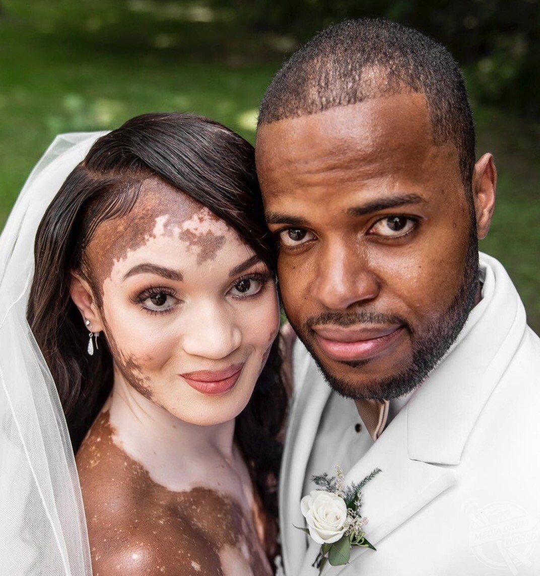 This Woman Thought Her Love Life Was Doomed Because Of Her Skin Condition Media Drum World 3980