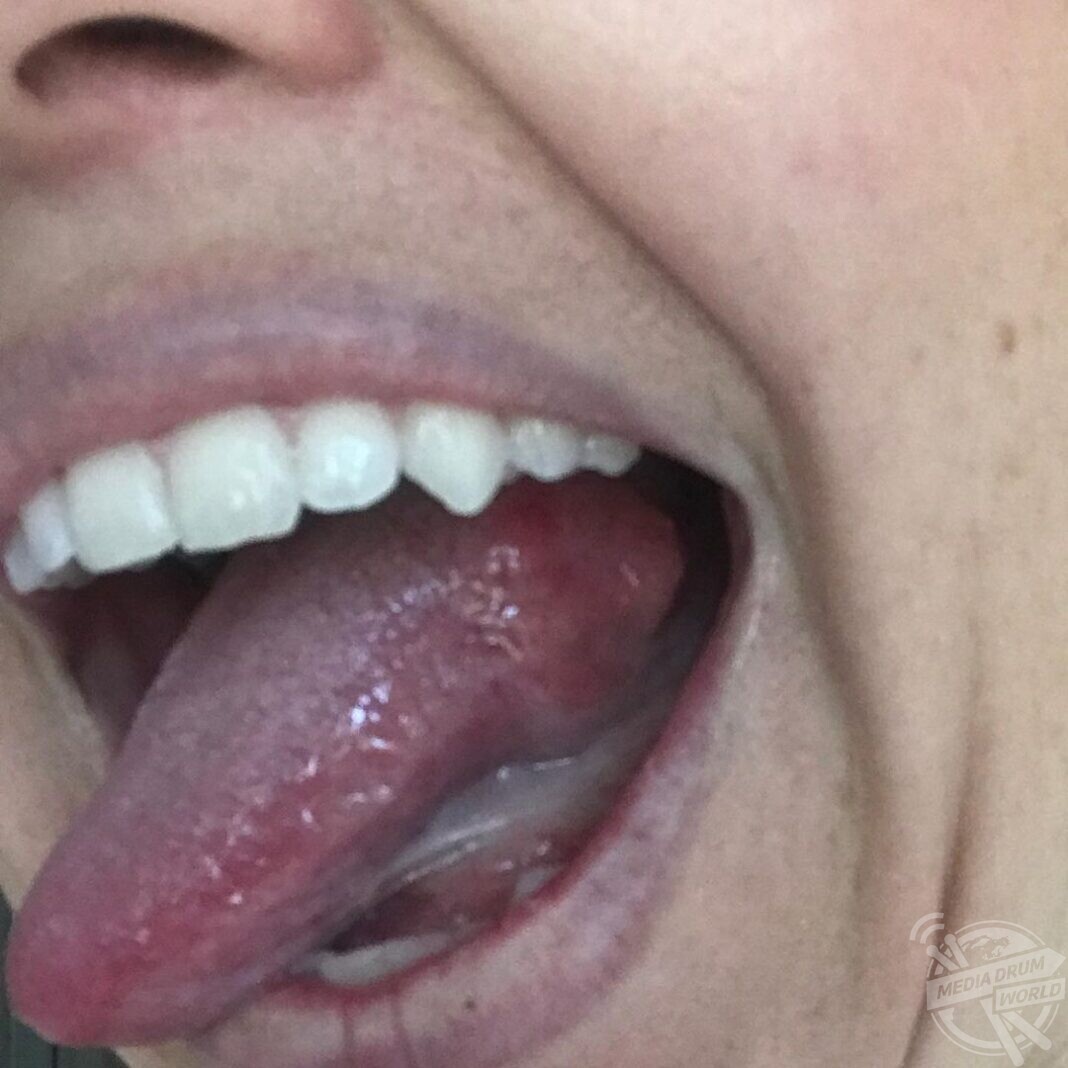 This Mum Had A Shock When A Bump On Her Tongue Ended Up Being Cancer Media Drum World